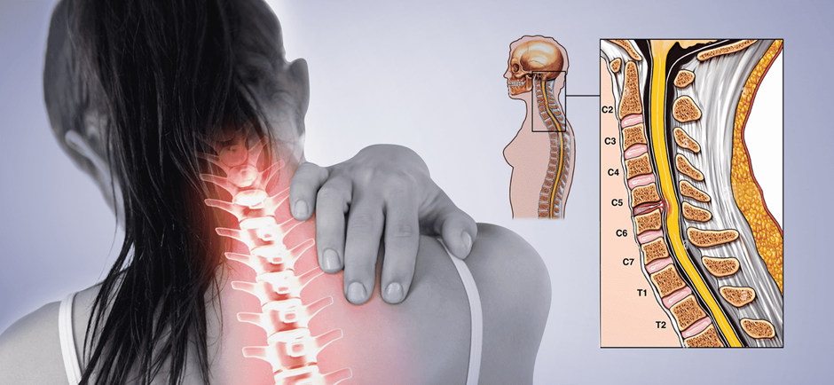 Understanding Bulging Discs: Causes, Symptoms, and Treatment Options