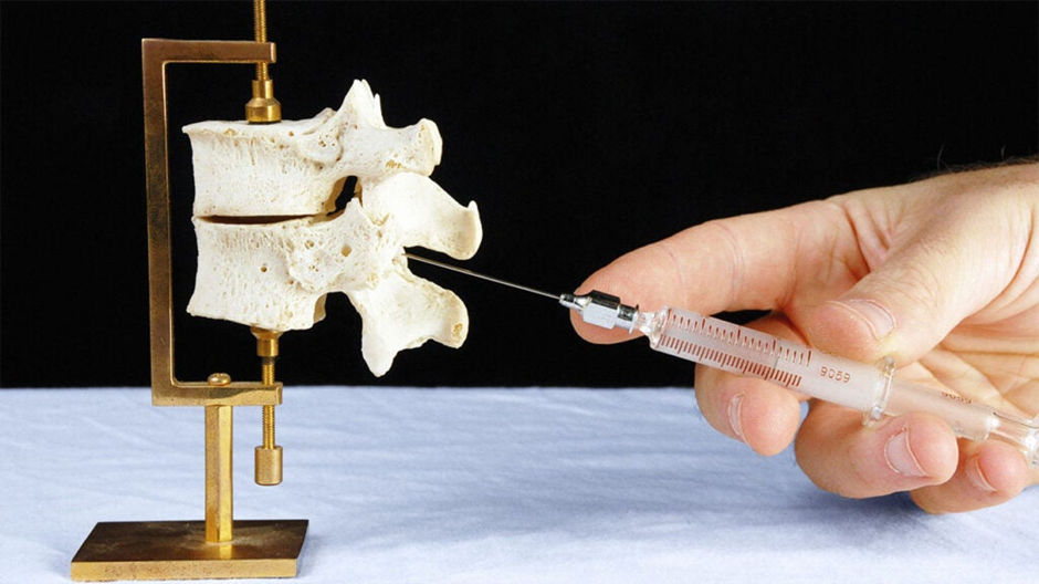 What Conditions Can Epidurals Treat? A Comprehensive Overview
