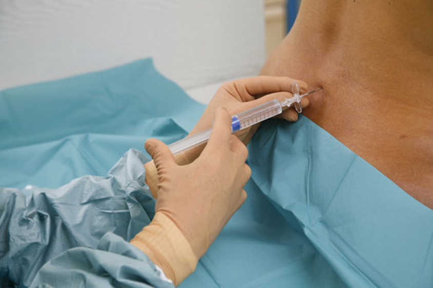 Epidural for Back Pain: Is It Right for You? Consult a Specialist
