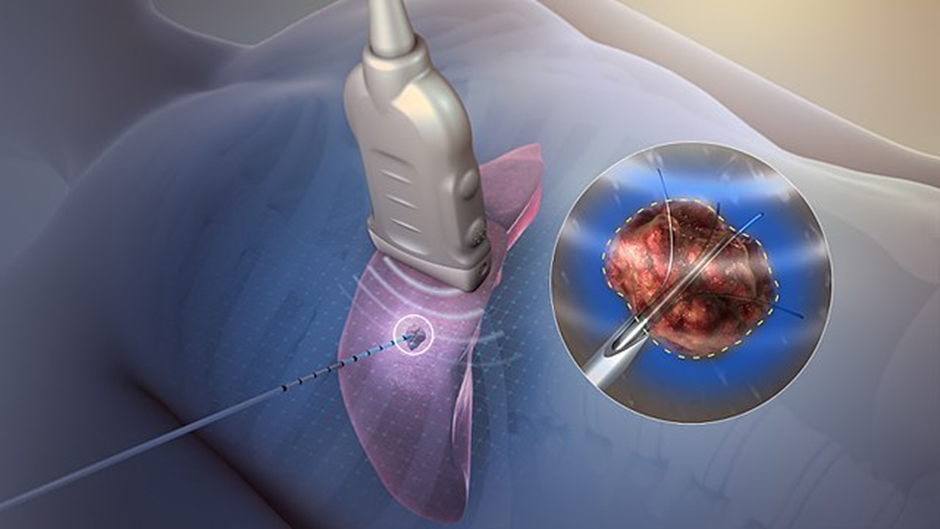 Radiofrequency Ablation for Pain Management: A Comprehensive Guide