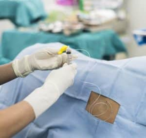 Radiofrequency Ablation vs. Other Pain Treatments: Pros and Cons
