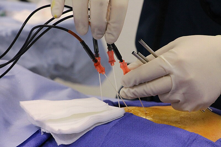 Radiofrequency Ablation Success Stories: Real-Life Pain Relief Experiences