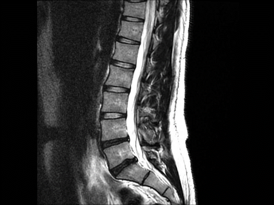 X-Rays and MRIs for Back Pain: Which Imaging Option Is Right for You?