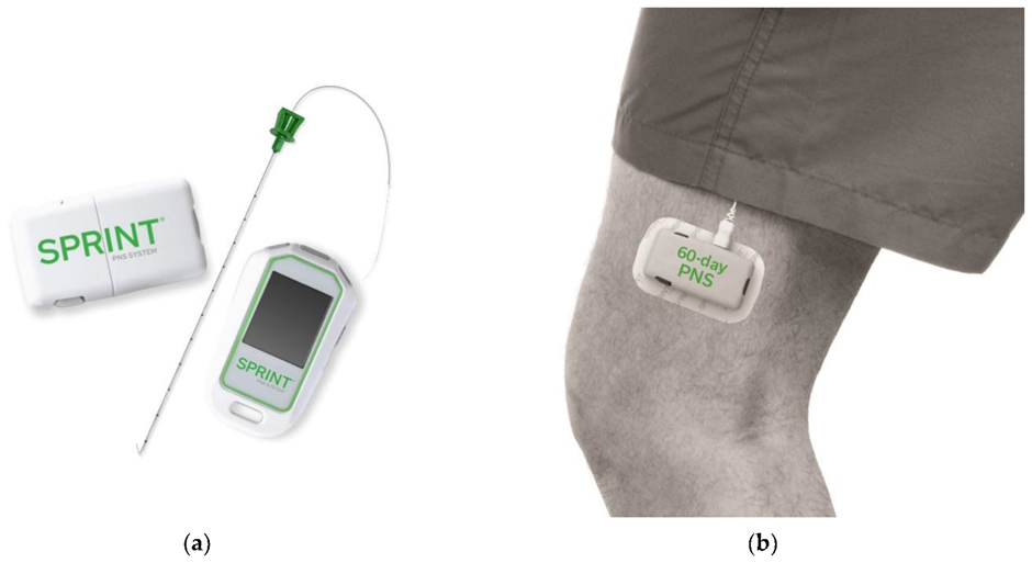 Peripheral Nerve Stimulation (PNS): Innovative Pain Management Unveiled
