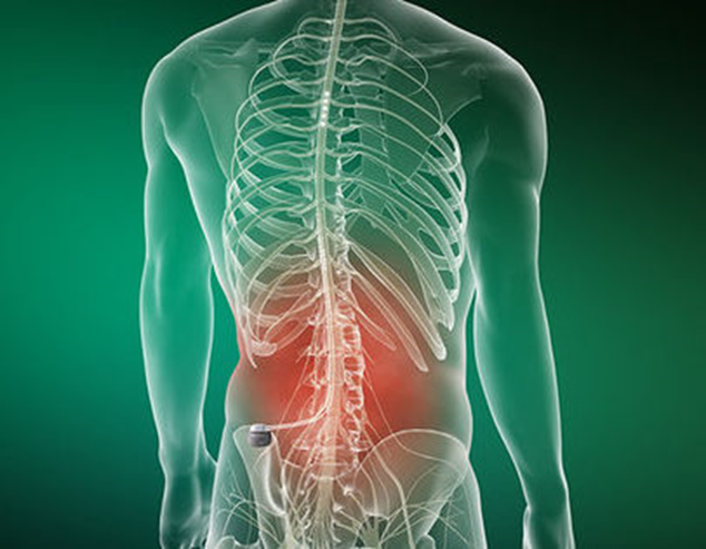 Spinal Cord Stimulation (SCS): A Breakthrough Solution for Chronic Pain