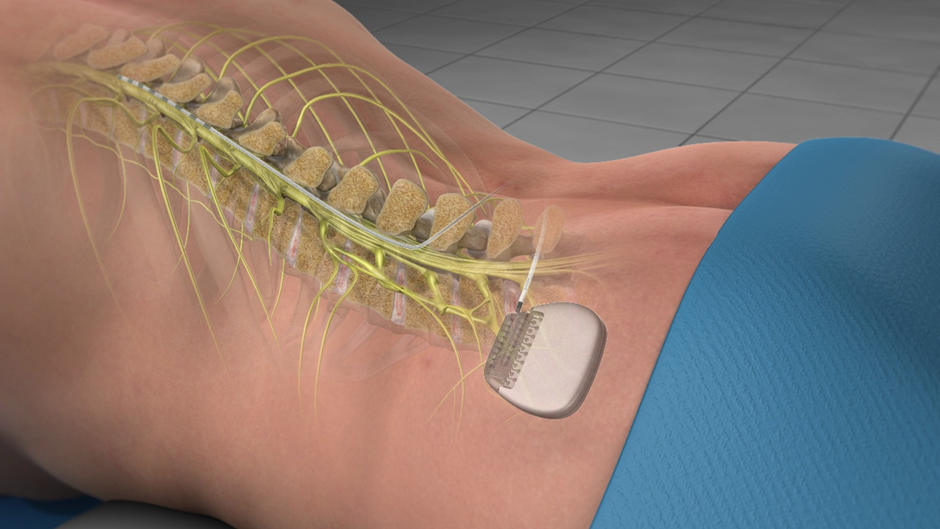 Understanding Spinal Cord Stimulation: How It Alleviates Persistent Pain