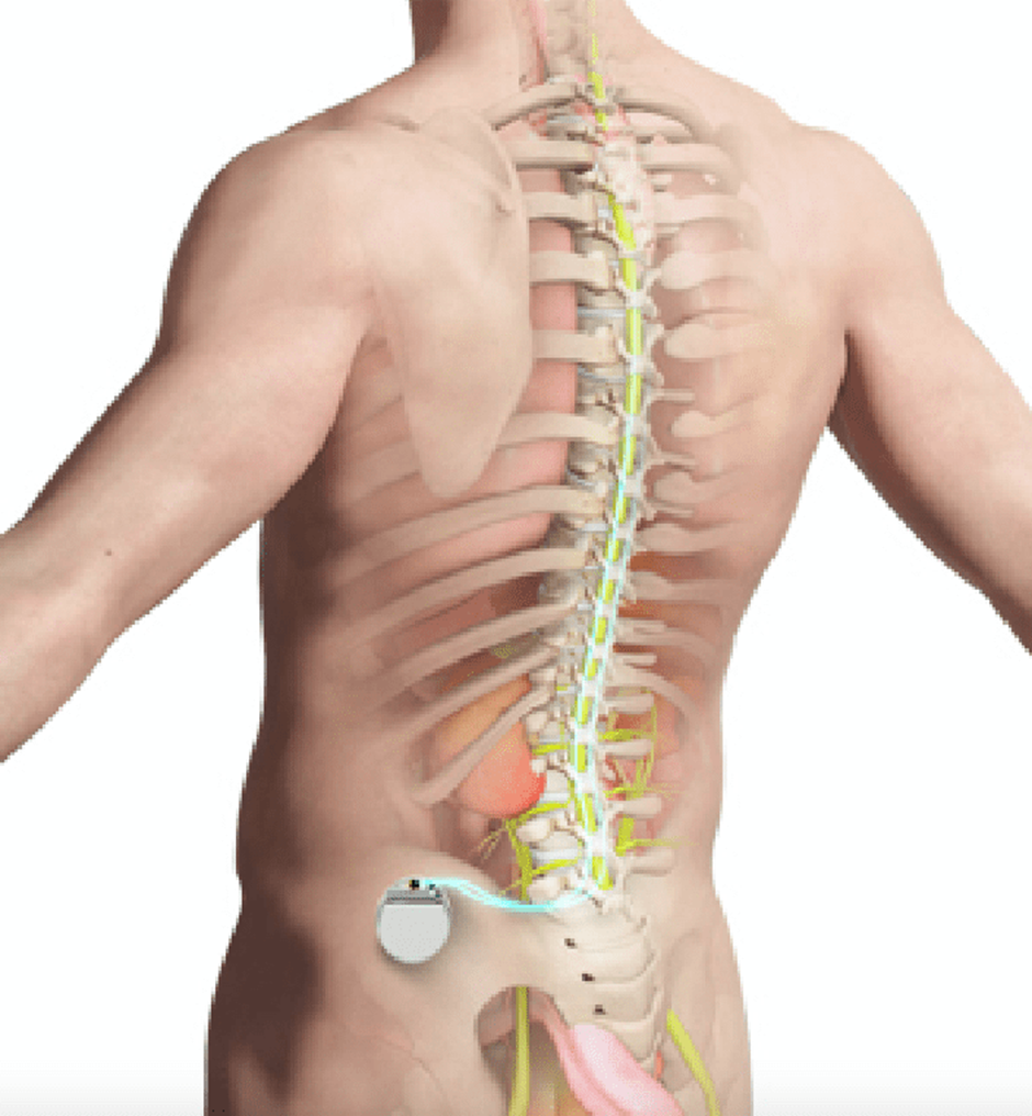 Choosing Spinal Cord Stimulation: Is It Right for Your Chronic Pain?