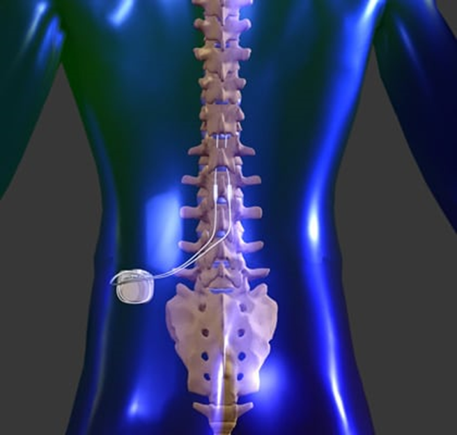 Choosing Spinal Cord Stimulation: Is It Right for Your Chronic Pain?