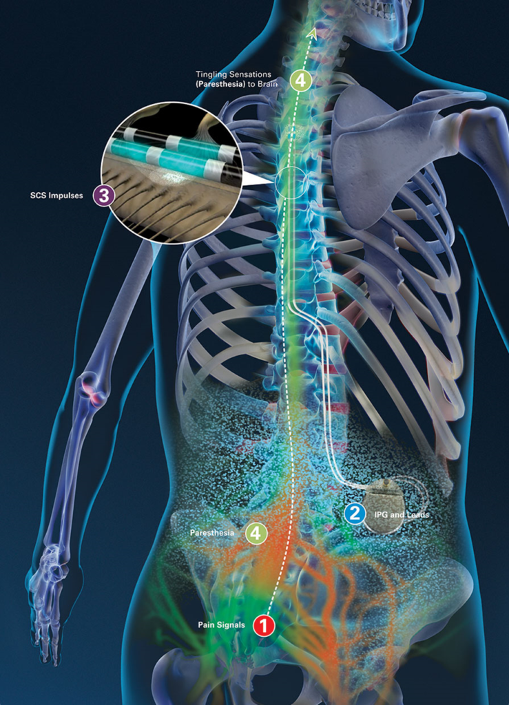 SCS for Back Pain: Targeted Relief for Lumbar Conditions