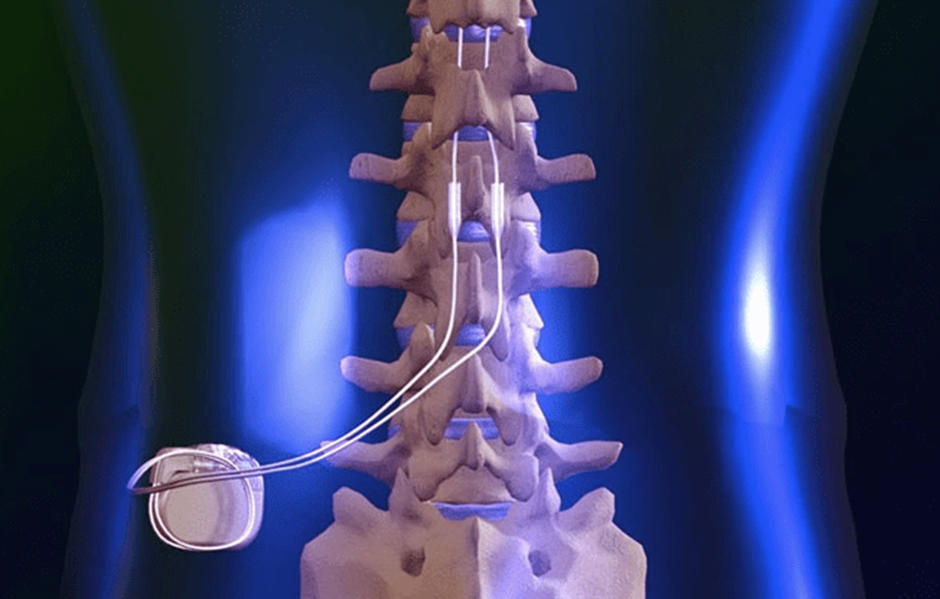 Patient Success Stories with Spinal Cord Stimulation: Real-Life Experiences