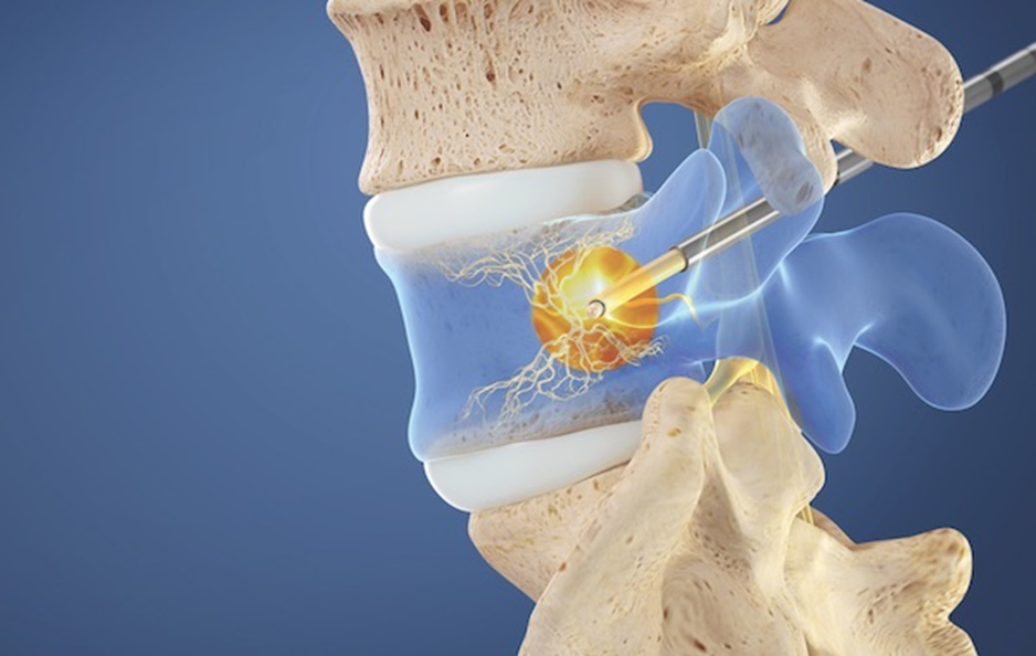 Intercept Procedure: A Minimally Invasive Solution for Chronic Back Pain