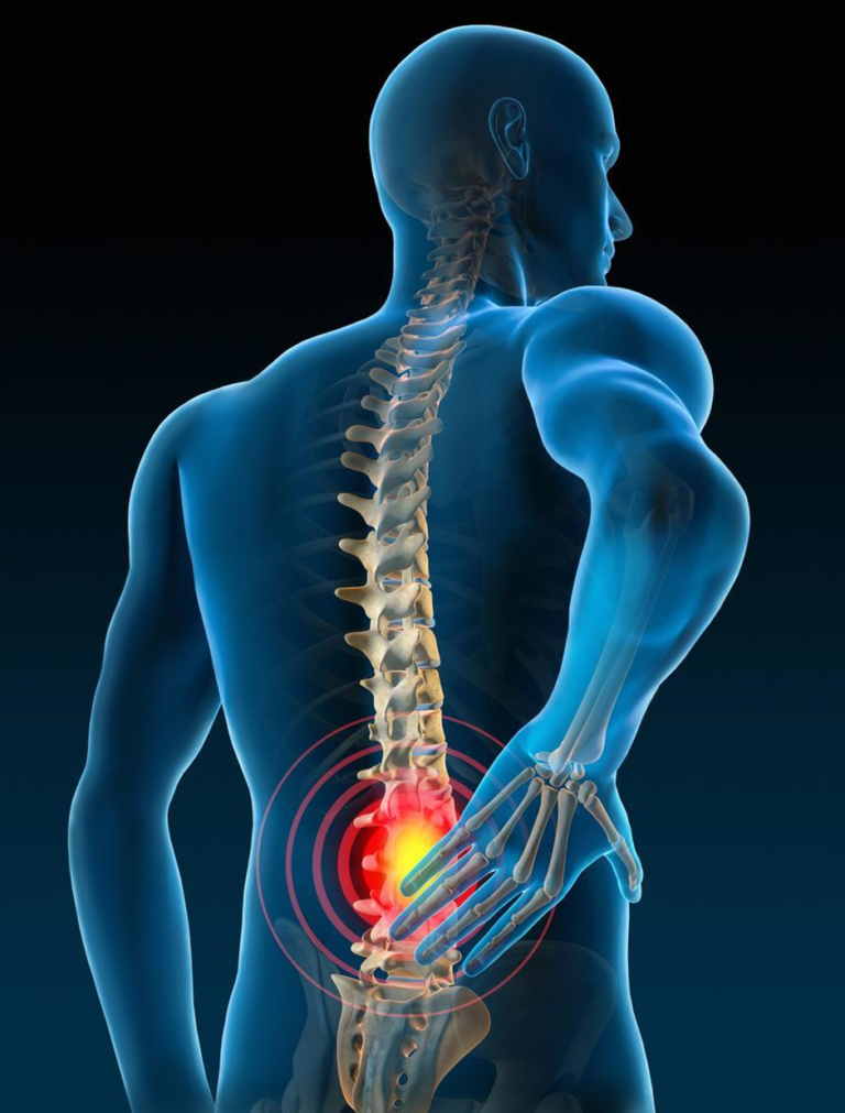 The Rear Approach Understanding Intracept: A Revolutionary Approach to Treating Back Pain ...
