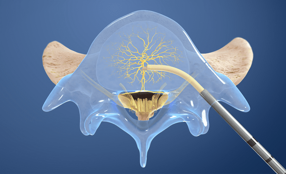 Understanding Intracept: A Revolutionary Approach to Treating Back Pain