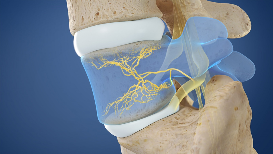 Understanding Intracept: A Revolutionary Approach to Treating Back Pain