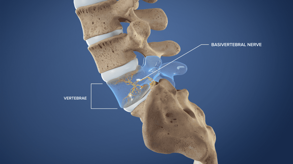 Living Pain-Free with Intracept: A Comprehensive Guide to the Procedure