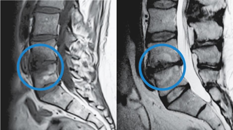 Intracept for Chronic Back Pain: How It Works and Who Benefits