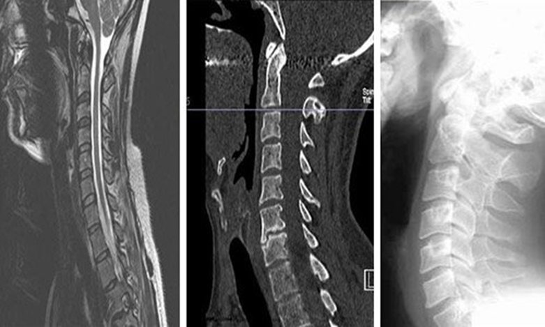 MRI or X-ray: Which is Better for Soft Tissue Injuries?