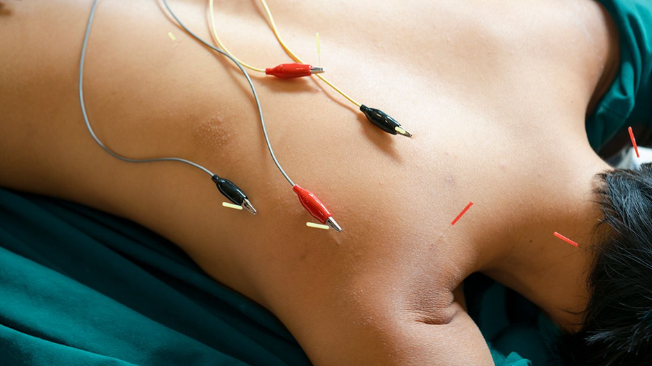 Can Acupuncture Relieve Chronic Pain Successfully?