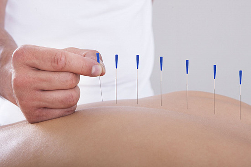 Can Acupuncture Relieve Chronic Pain Successfully?