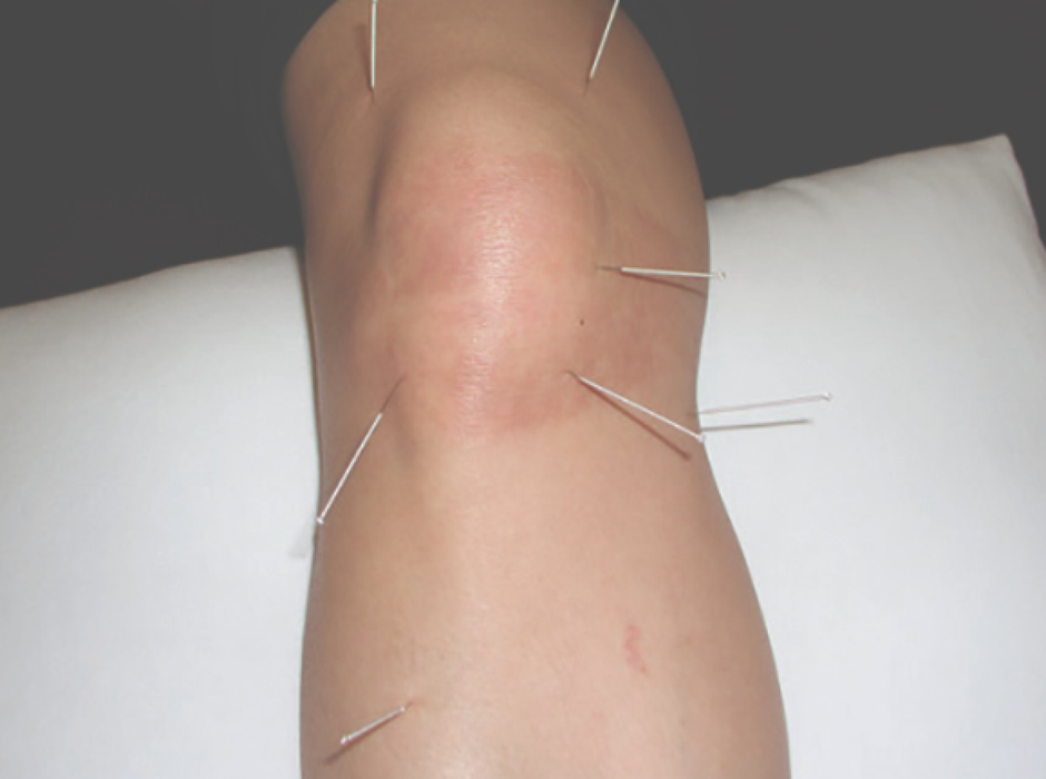 How Does Acupuncture Work to Alleviate Pain?