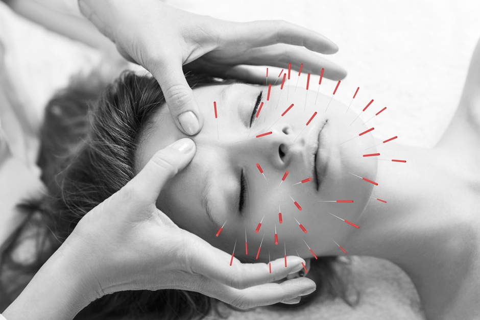 Can Acupuncture Help with Migraines and Headaches?
