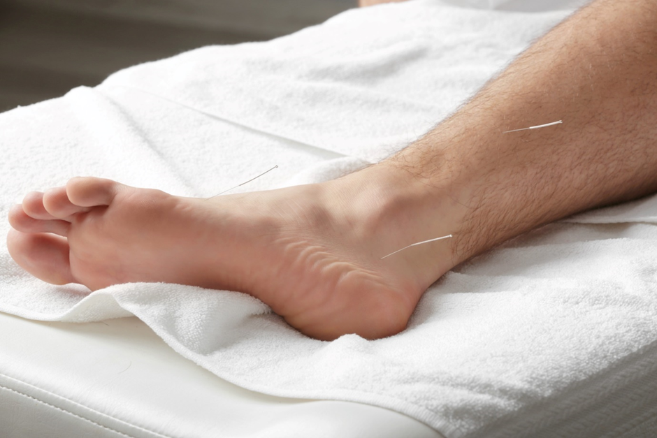 Can Acupuncture Be Used Alongside Conventional Pain Treatments?