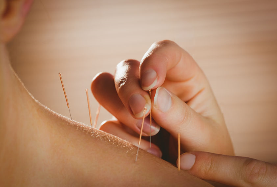 Is Acupuncture Safe for Pain Management?