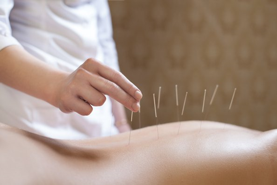 What Research Evidence Supports Acupuncture for Pain Relief?