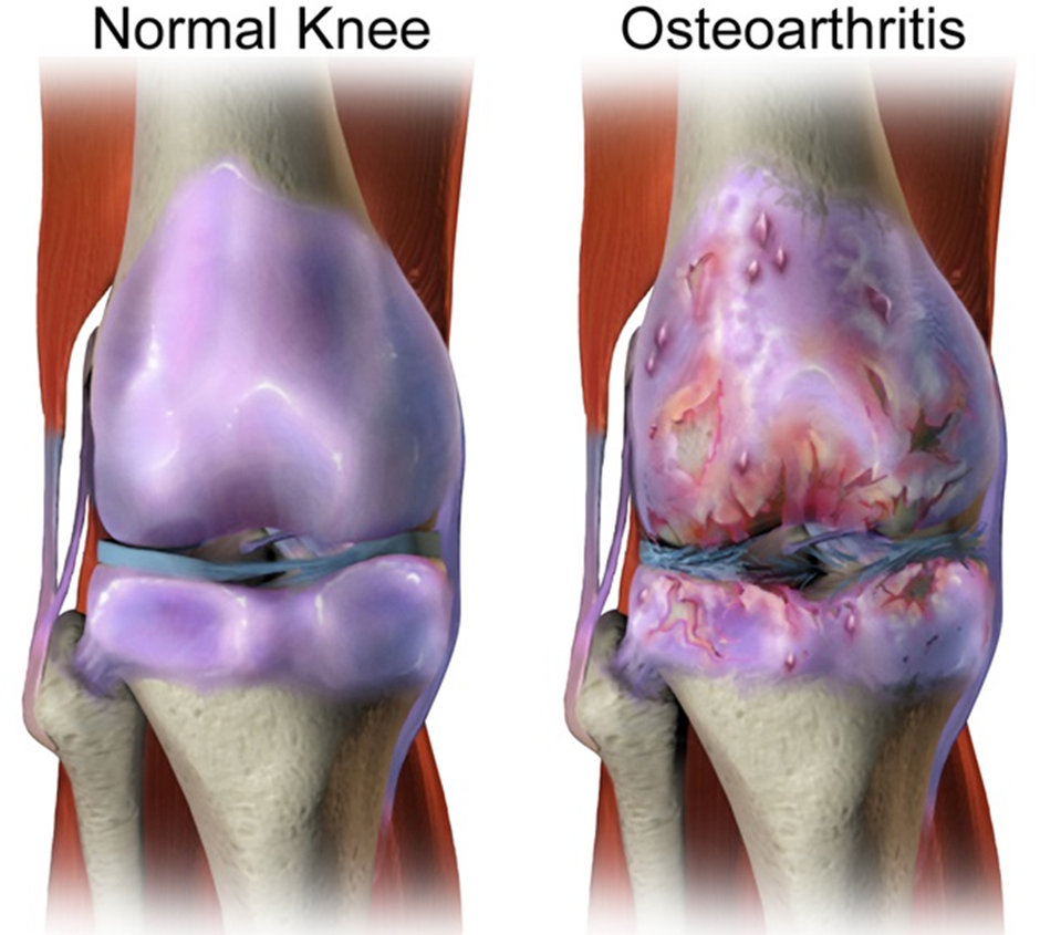 Chronic Knee Pain: Identifying Underlying Conditions and Long-Term Management